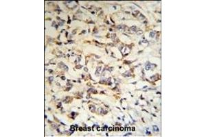 CPN2 Antibody (N-term) (R) IHC analysis in formalin fixed and paraffin embedded human breast carcinoma tissue followed by peroxidase conjugation of the secondary antibody and DAB staining. (CPN2 抗体  (N-Term))