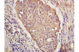Formalin-fixed and paraffin embedded Human lung carcinoma labeled with Anti-IRF9 Polyclonal Antibody, Unconjugated (ABIN2177064) at 1:300 followed by conjugation to the secondary antibody and DAB staining (IRF9 抗体  (AA 101-200))