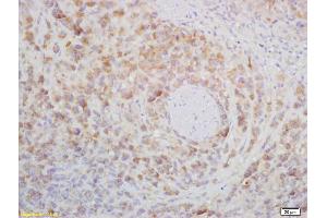 Formalin-fixed and paraffin embedded mouse lymphoma labeled with Rabbit Anti CD272/BTLA Polyclonal Antibody, Unconjugated (ABIN671031) at 1:200 followed by conjugation to the secondary antibody and DAB staining (BTLA 抗体  (AA 221-289))