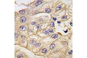 IHC analysis of FFPE human lung carcinoma tissue stained with anti-TLR2 antibody (TLR2 抗体  (AA 720-749))