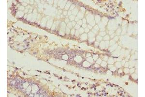 Immunohistochemistry of paraffin-embedded human colon cancer using ABIN7156542 at dilution of 1:100 (ICAM4 抗体  (AA 20-140))