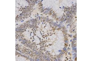 Immunohistochemistry of paraffin-embedded human rectal cancer tissue using H3K79me3 antibody at dilution of 1:200 (x400 lens).