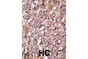 Formalin-fixed and paraffin-embedded human cancer tissue reacted with the primary antibody, which was peroxidase-conjugated to the secondary antibody, followed by AEC staining. (ATG4A 抗体  (AA 1-30))