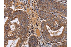 The image on the left is immunohistochemistry of paraffin-embedded Human colon cancer tissue using ABIN7130361(NDUFA1 Antibody) at dilution 1/70, on the right is treated with fusion protein. (NDUFA1 抗体)