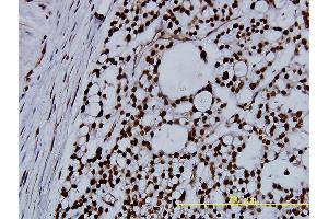 Immunoperoxidase of monoclonal antibody to NPM1 on formalin-fixed paraffin-embedded human ovary, clear cell carcinoma tissue. (NPM1 抗体  (AA 1-294))