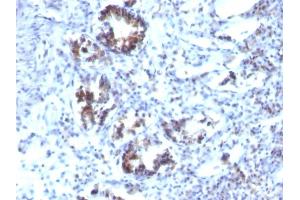 Formalin-fixed, paraffin-embedded human Colon Carcinoma stained with Transgelin Monoclonal Antibody (SPM606) (Transgelin 抗体)