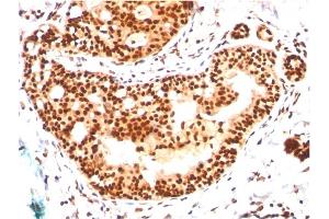 Formalin-fixed, paraffin-embedded human Breast Carcinoma stained with SUMO-2/3 Mouse Monoclonal Antibody (SM23/496) (SUMO2 抗体)