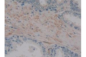 Immunohistochemistry (IHC) image for anti-Matrix Metallopeptidase 14 (Membrane-inserted) (MMP14) (AA 322-541) antibody (ABIN7442336)