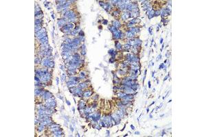 Immunohistochemistry of paraffin-embedded human colon carcinoma using RALB antibody (ABIN6293713) at dilution of 1:100 (40x lens). (RALB 抗体)