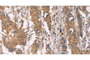 Immunohistochemistry of paraffin-embedded Human gastric cancer using PLIN2 Polyclonal Antibody at dilution of 1:30 (ADRP 抗体)