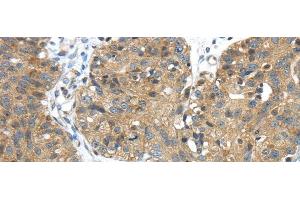 Immunohistochemistry of paraffin-embedded Human breast cancer tissue using TMPRSS11E Polyclonal Antibody at dilution 1:45 (TMPRSS11E 抗体)