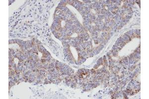IHC-P Image Immunohistochemical analysis of paraffin-embedded human endo mitral ovarian cancer, using ARPC3, antibody at 1:100 dilution. (ARPC3 抗体)