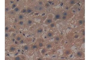 Detection of GCLM in Human Liver cancer Tissue using Polyclonal Antibody to Glutamate Cysteine Ligase, Modifier Subunit (GCLM) (GCLM 抗体  (AA 40-251))