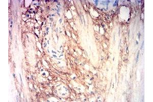 Immunohistochemical analysis of paraffin-embedded stomach cancer tissues using COL3A1 mouse mAb with DAB staining. (COL3A1 抗体  (AA 24-153))