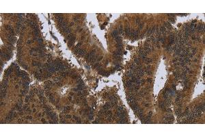 Immunohistochemistry of paraffin-embedded Human colon cancer tissue using PIP Polyclonal Antibody at dilution 1:50 (PIP 抗体)