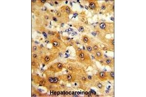 Formalin-fixed and paraffin-embedded human hepatocarcinoma reacted with RPS15 Antibody (N-term), which was peroxidase-conjugated to the secondary antibody, followed by DAB staining. (RPS15 抗体  (N-Term))