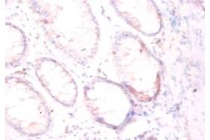 Immunohistochemistry of paraffin-embedded human colorectal carcinoma using FOLH1 / PSMA antibody at dilution of 1:50. (PSMA 抗体  (Biotin))