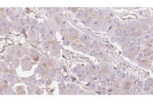 ABIN6272715 at 1/100 staining Human liver cancer tissue by IHC-P. (OR1E2 抗体  (C-Term))