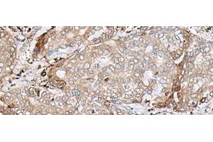 Immunohistochemistry of paraffin-embedded Human liver cancer tissue using MRM1 Polyclonal Antibody at dilution of 1:85(x200) (MRM1 抗体)