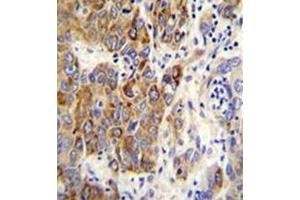 Formalin fixed, paraffin embedded human hepatocarcinoma stained with CYP2B6 Antibody (Center) followed by peroxidase conjugation of the secondary antibody and DAB staining. (CYP2B6 抗体  (Middle Region))