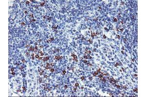Immunohistochemical staining of paraffin-embedded Human lymphoma tissue using anti-IGJ mouse monoclonal antibody. (IGJ 抗体)
