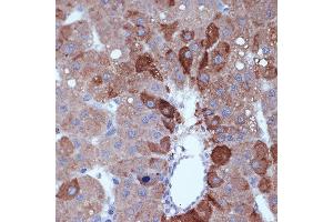Immunohistochemistry of paraffin-embedded human liver cancer using Cyclin B2 Rabbit mAb (ABIN7266557) at dilution of 1:100 (40x lens). (Cyclin B2 抗体)