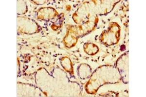 Immunohistochemistry of paraffin-embedded human gastric cancer using ABIN7162782 at dilution of 1:100 (PGLYRP4 抗体  (AA 18-317))