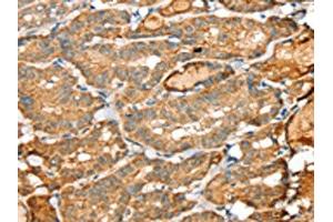 The image on the left is immunohistochemistry of paraffin-embedded Human thyroid cancer tissue using ABIN7192361(SIGLEC14 Antibody) at dilution 1/30, on the right is treated with synthetic peptide. (SIGLEC14 抗体)