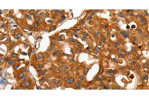 Immunohistochemistry of paraffin-embedded Human lung cancer using CAP2 Polyclonal Antibody at dilution of 1:50 (CAP2 抗体)