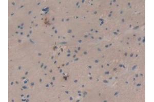 IHC-P analysis of Human Colorectal cancer Tissue, with DAB staining. (SLURP1 抗体  (AA 1-103))