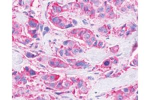 Anti-FFAR3 / GPR41 antibody IHC of human Breast, Carcinoma. (FFAR3 抗体  (Internal Region))