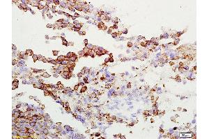Formalin-fixed and paraffin embedded rat lung carcinoma labeled with Anti-Gamma-Adaptin Polyclonal Antibody, Unconjugated  at 1:200 followed by conjugation to the secondary antibody and DAB staining (gamma 1 Adaptin 抗体  (AA 721-822))