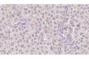 ABIN6276805 at 1/100 staining Human melanoma tissue by IHC-P. (Vitronectin 抗体  (Internal Region))