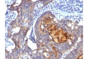 Immunohistochemical staining (Formalin-fixed paraffin-embedded sections) of human colon carcinoma with ECM1 monoclonal antibody, clone ECM1/792 . (ECM1 抗体)