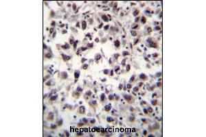 SFRS7 Antibody (N-term) (ABIN656240 and ABIN2845556) immunohistochemistry analysis in formalin fixed and paraffin embedded human hepatocarcinoma tissue followed by peroxidase conjugation of the secondary antibody and DAB staining. (SFRS7 抗体  (N-Term))