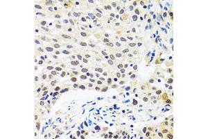 Immunohistochemistry of paraffin-embedded human lung cancer using MYOG antibody (ABIN5974015) at dilution of 1/100 (40x lens). (Myogenin 抗体)