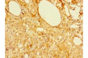 Immunohistochemistry of paraffin-embedded human prostate cancer using ABIN7160129 at dilution of 1:100 (MFSD5 抗体  (AA 216-248))