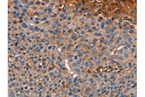 The image on the left is immunohistochemistry of paraffin-embedded Human breast cancer tissue using ABIN7130441(NOC2L Antibody) at dilution 1/20, on the right is treated with fusion protein. (NOC2L 抗体)