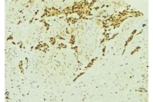 ABIN6277137 at 1/100 staining Human breast cancer tissue by IHC-P. (ATF2 抗体  (N-Term))