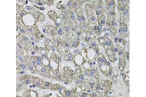 Immunohistochemistry of paraffin-embedded Human liver damage using GFPT1 Polyclonal Antibody at dilution of 1:100 (40x lens). (GFPT1 抗体)