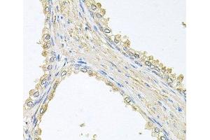 Immunohistochemistry of paraffin-embedded Human prostate using PMM2 Polyclonal Antibody at dilution of 1:100 (40x lens). (PMM2 抗体)