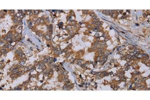 Immunohistochemistry of paraffin-embedded Human liver cancer using REG3G Polyclonal Antibody at dilution of 1:40 (REG3g 抗体)