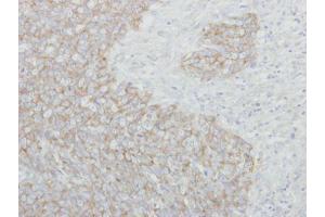 IHC-P Image Immunohistochemical analysis of paraffin-embedded human breast cancer, using NARS, antibody at 1:250 dilution. (NARS 抗体)