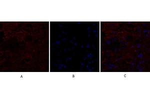 Immunofluorescence analysis of human breast cancer tissue. (IL-8 抗体  (C-Term))