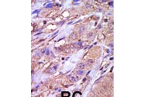Formalin-fixed and paraffin-embedded human cancer tissue reacted with the primary antibody, which was peroxidase-conjugated to the secondary antibody, followed by DAB staining. (CK1 epsilon 抗体  (C-Term))