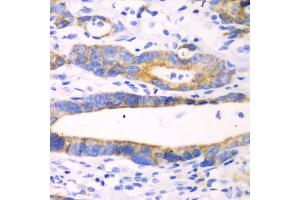Immunohistochemistry of paraffin-embedded human gastric cancer using CHIA antibody (ABIN5971776) at dilution of 1/100 (40x lens). (CHIA 抗体)
