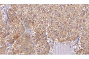 ABIN6277481 at 1/100 staining Human Melanoma tissue by IHC-P. (Neurotrophin 4 抗体  (Internal Region))