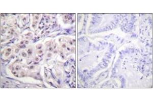 Immunohistochemistry analysis of paraffin-embedded human lung carcinoma tissue, using hnRPD (Ab-83) Antibody. (HNRNPD/AUF1 抗体  (AA 49-98))