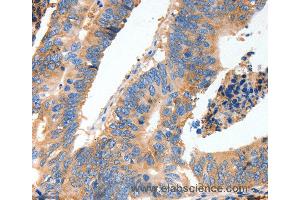 Immunohistochemistry of Human thyroid cancer using MUC6 Polyclonal Antibody at dilution of 1:40 (MUC6 抗体)