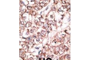 Formalin-fixed and paraffin-embedded human cancer tissue reacted with the primary antibody, which was peroxidase-conjugated to the secondary antibody, followed by DAB staining. (DKK2 抗体  (N-Term))